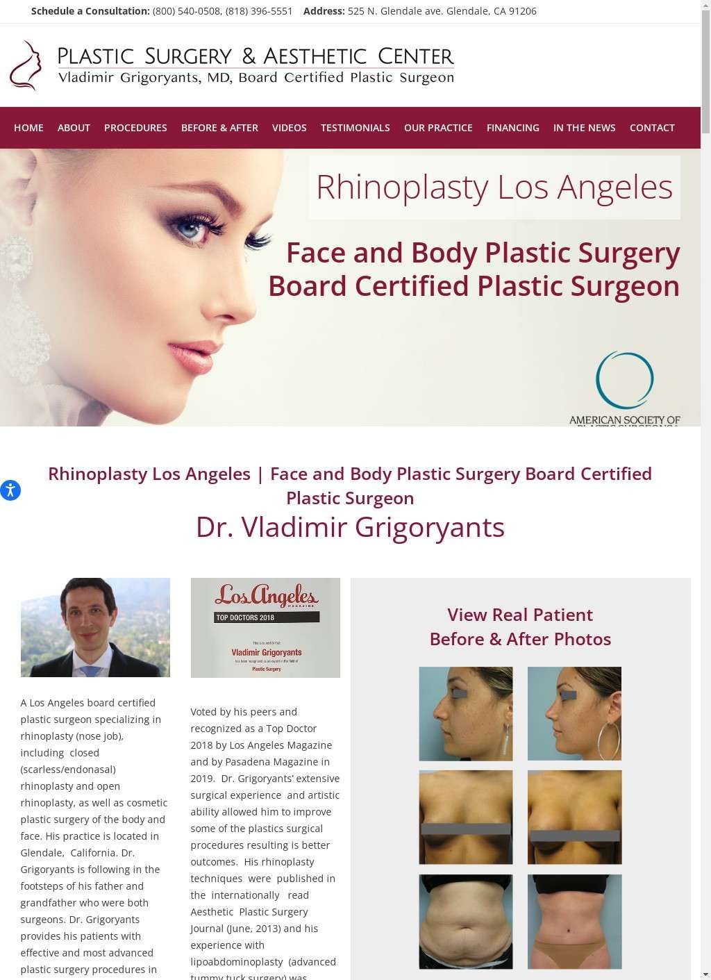 Rhinoplasty Los Angeles